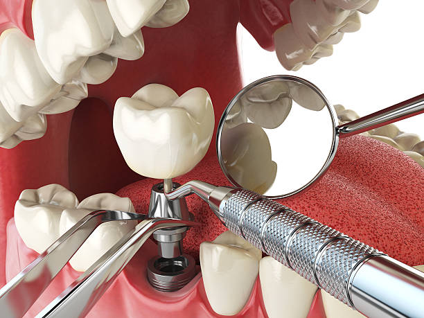Best Emergency Tooth Extraction in Three Rivers, CA